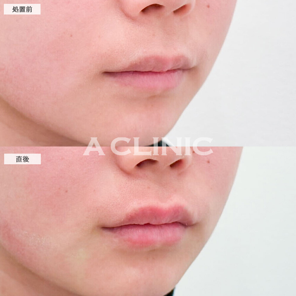 リップヒアルロン酸注入でグロスなしでも立体的な唇に！処置前と直後の症例です(20代女性)