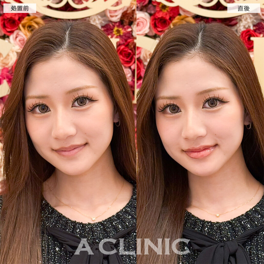 スマイルリップで人中も短くなり化粧も楽になりました！こちら処置前と直後の症例です(20代女性)