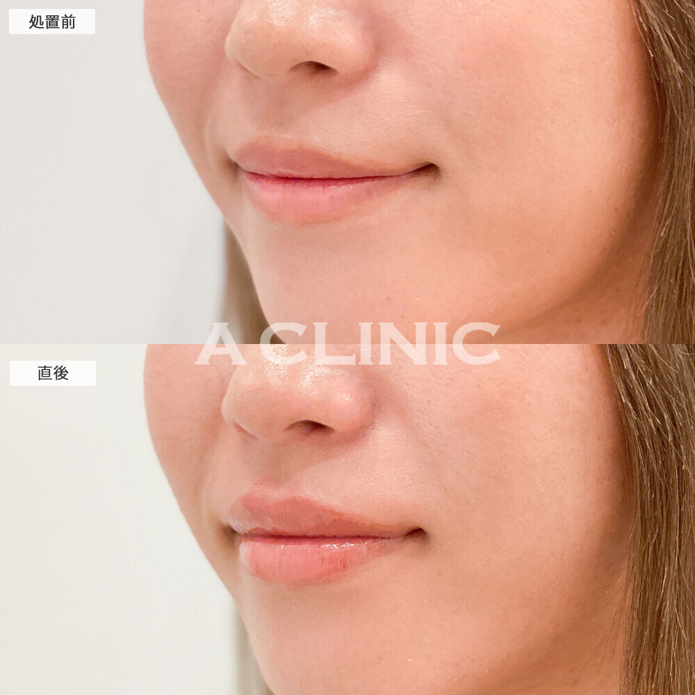 スマイルリップでナチュラルに形を整えながらボリュームアップ！こちら処置前と直後の症例です(20代女性)