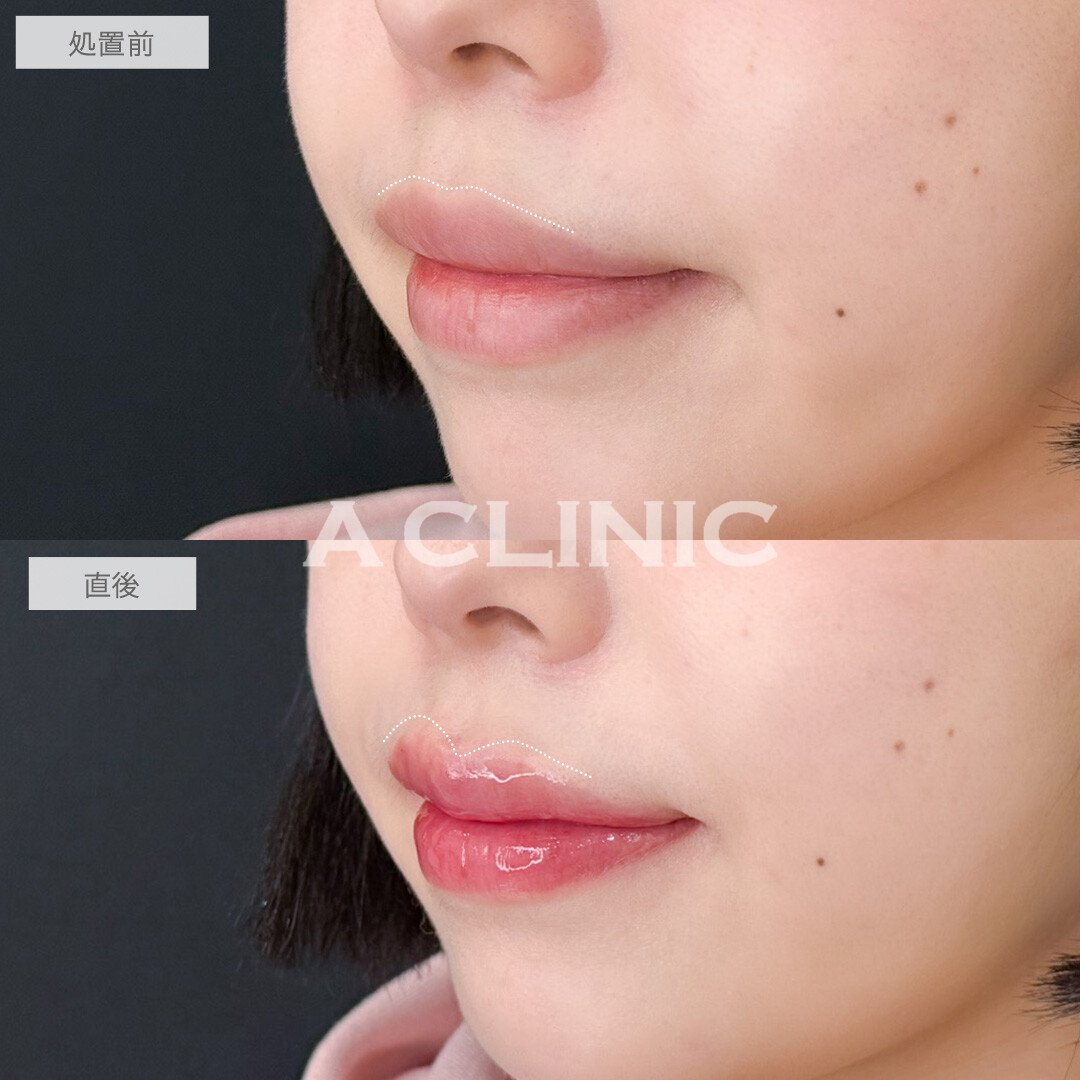 スマイルリップでM字リップになって人中も短縮！こちら処置前と直後の症例です(20代女性)