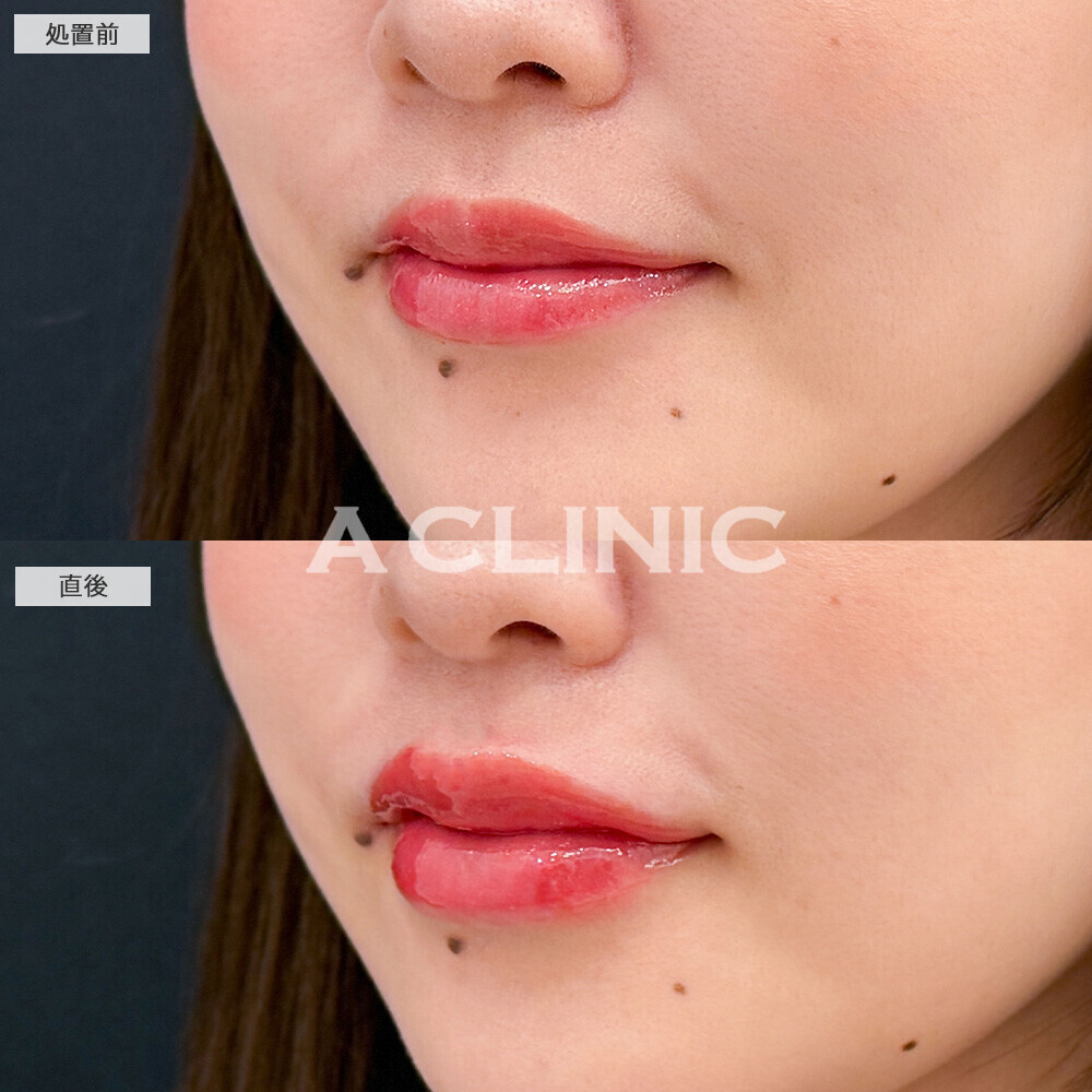スマイルリップで適度な厚みが出てパーツがはっきりしました！こちら処置前と直後の症例です(20代女性)