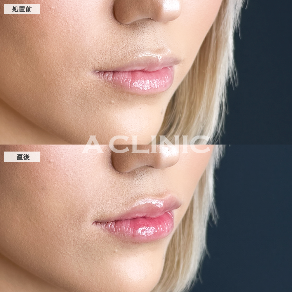 唇のヒアルロン酸注入でぷっくり印象的な口元に！こちらスマイルリップの施術前と直後の症例です(20代女性)