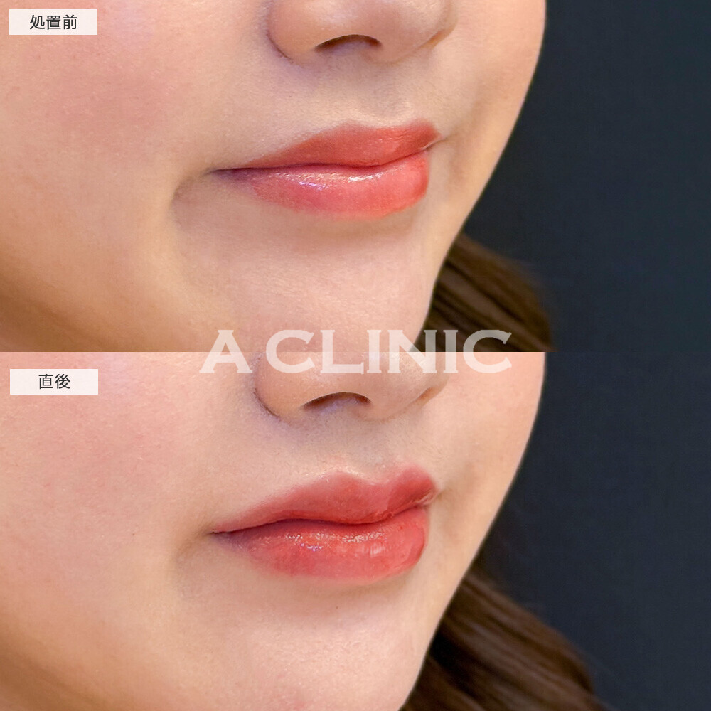 スマイルリップで存在感のある可愛い唇に！こちら処置前と直後の症例です(20代女性)