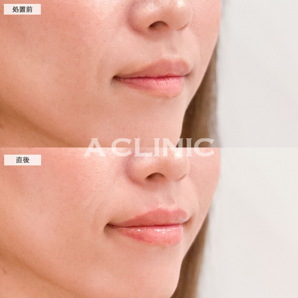 スマイルリップでナチュラルに形を整えながらボリュームアップ！こちら処置前と直後の症例です(20代女性)
