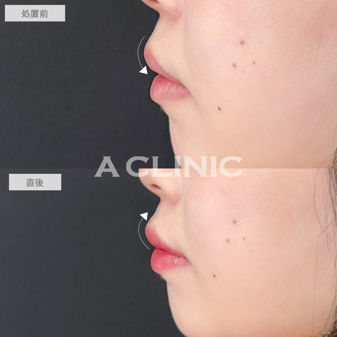スマイルリップでM字リップになって人中も短縮！こちら処置前と直後の症例です(20代女性)