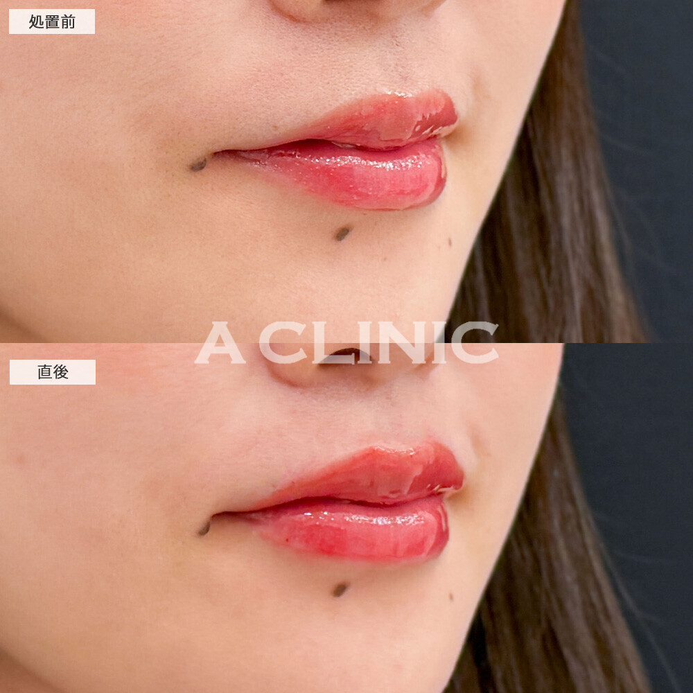 スマイルリップで適度な厚みが出てパーツがはっきりしました！こちら処置前と直後の症例です(20代女性)