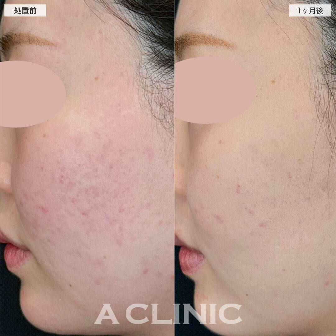A式美肌サブシジョンと手打ち水光注射でニキビ跡の凹みが改善しました！処置前と1ヶ月後の症例です(20代女性)