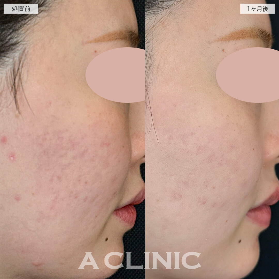 A式美肌サブシジョンと手打ち水光注射でニキビ跡の凹みが改善しました！処置前と1ヶ月後の症例です(20代女性)