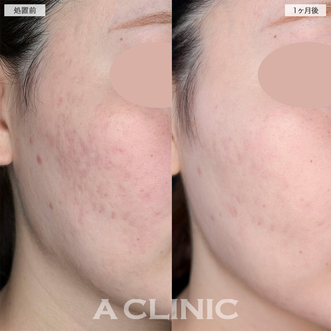 A式美肌サブシジョンと手打ち水光注射でニキビ跡の凹みが改善しました！処置前と1ヶ月後の症例です(20代女性)
