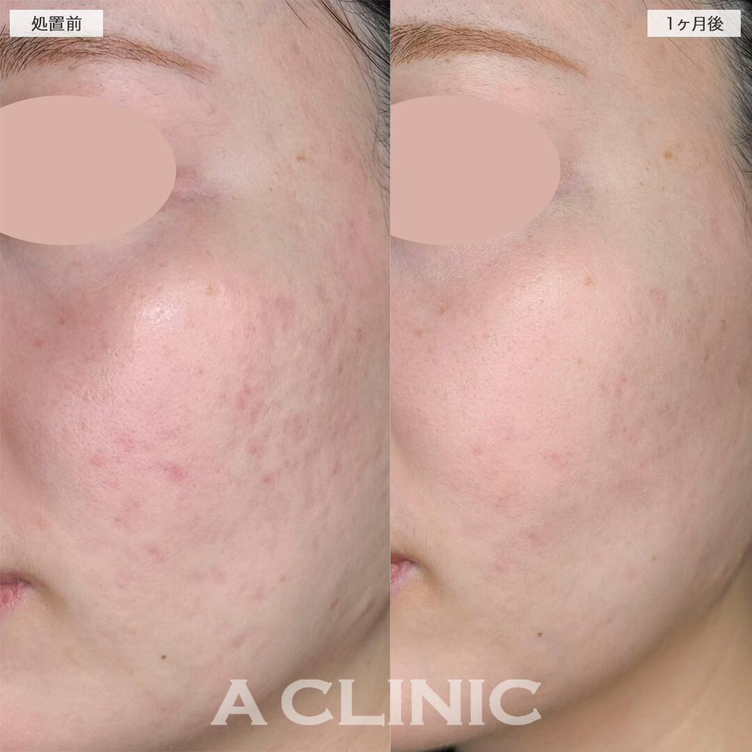 A式美肌サブシジョンと手打ち水光注射でニキビ跡の凹みが改善しました！処置前と1ヶ月後の症例です(20代女性)