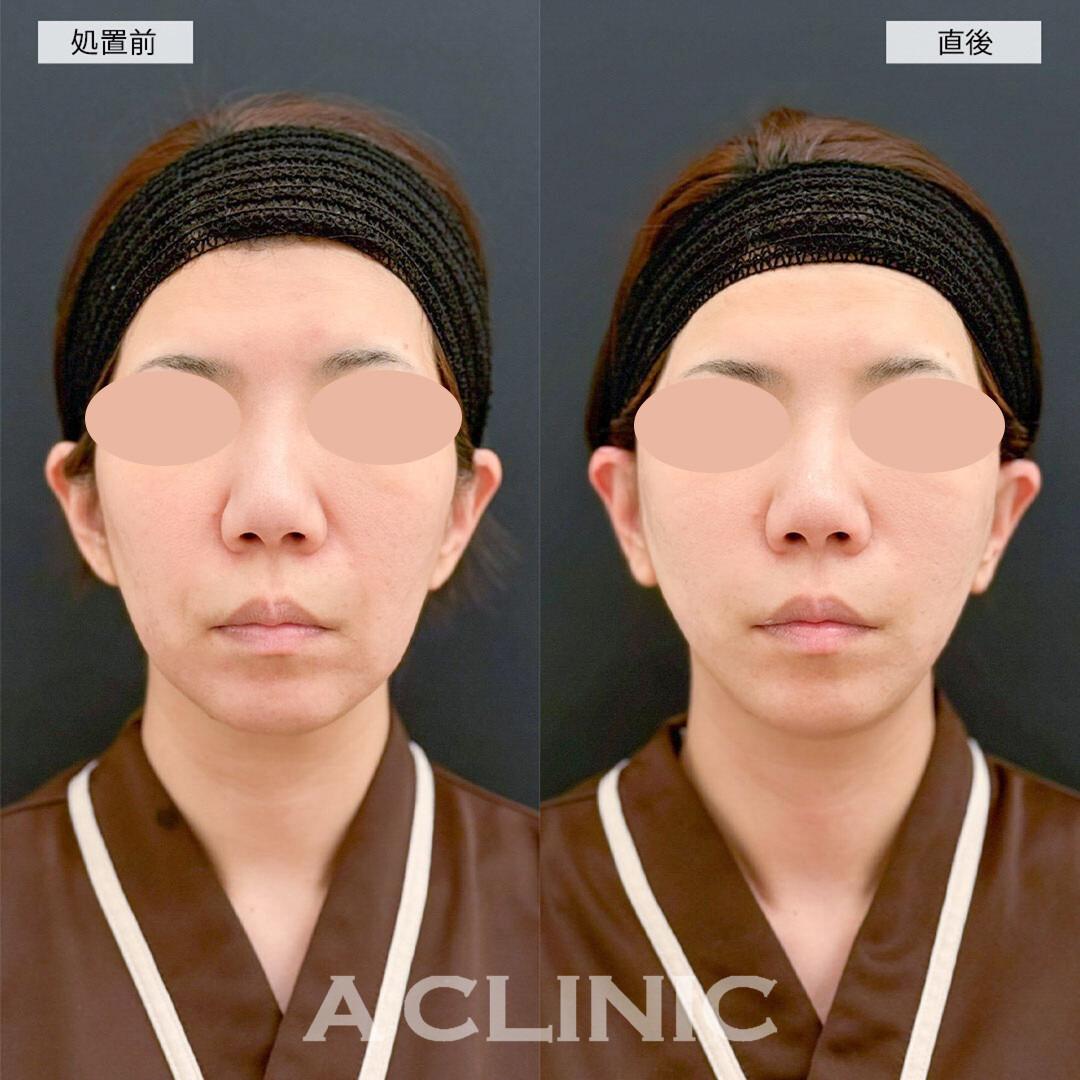 A式美肌たるみ切開はダウンタイムが少なく直後からしっかり引きあがります！こちら処置前と直後の症例です(30代女性)