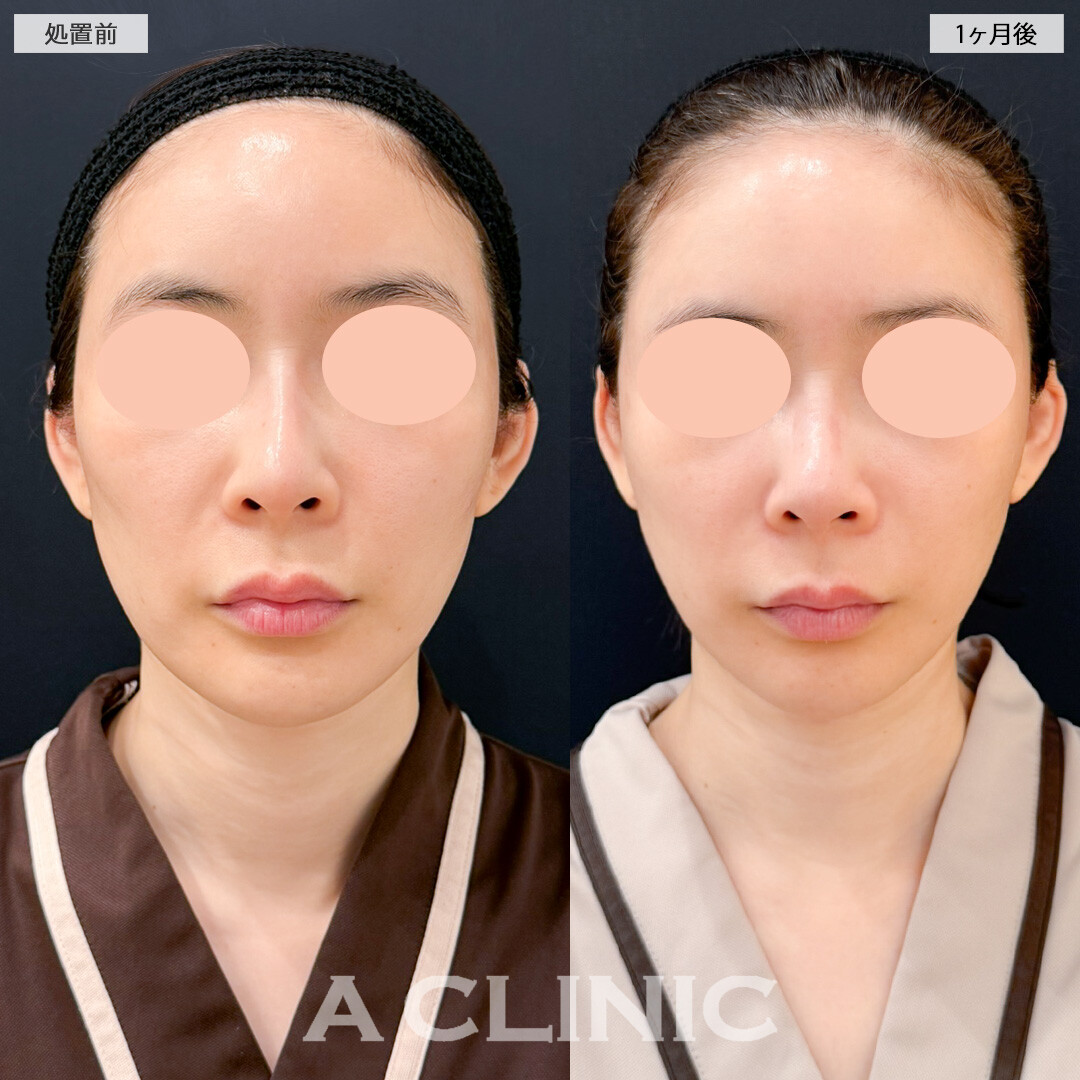 A式美肌たるみ切開とナゾラビアルファット除去術でほうれい線にWでアプローチ！処置前と1ヶ月後の症例です(40代女性)