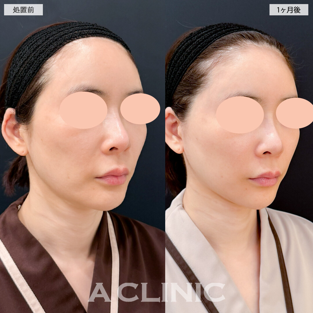 A式美肌たるみ切開とナゾラビアルファット除去術でほうれい線にWでアプローチ！処置前と1ヶ月後の症例です(40代女性)