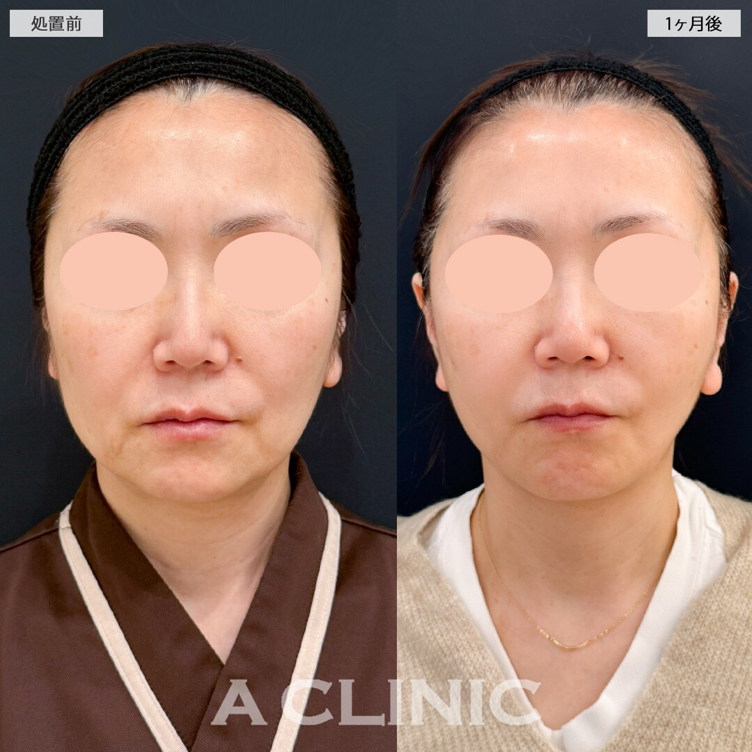 【直後の傷跡あり】1day小顔脂肪吸引とA式美肌たるみ切開でほうれい線と顔周りのたるみが気にならなくなりました！処置前と1ヶ月後の症例です(50代女性)