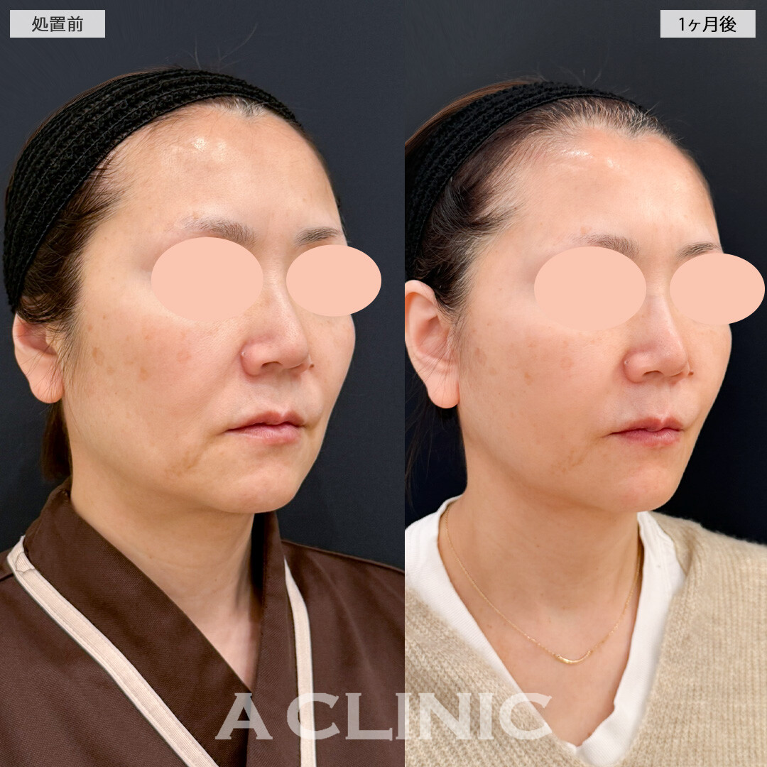 【直後の傷跡あり】1day小顔脂肪吸引とA式美肌たるみ切開でほうれい線と顔周りのたるみが気にならなくなりました！処置前と1ヶ月後の症例です(50代女性)