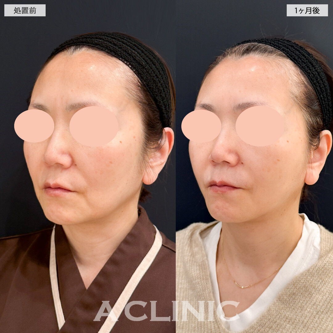 【直後の傷跡あり】1day小顔脂肪吸引とA式美肌たるみ切開でほうれい線と顔周りのたるみが気にならなくなりました！処置前と1ヶ月後の症例です(50代女性)