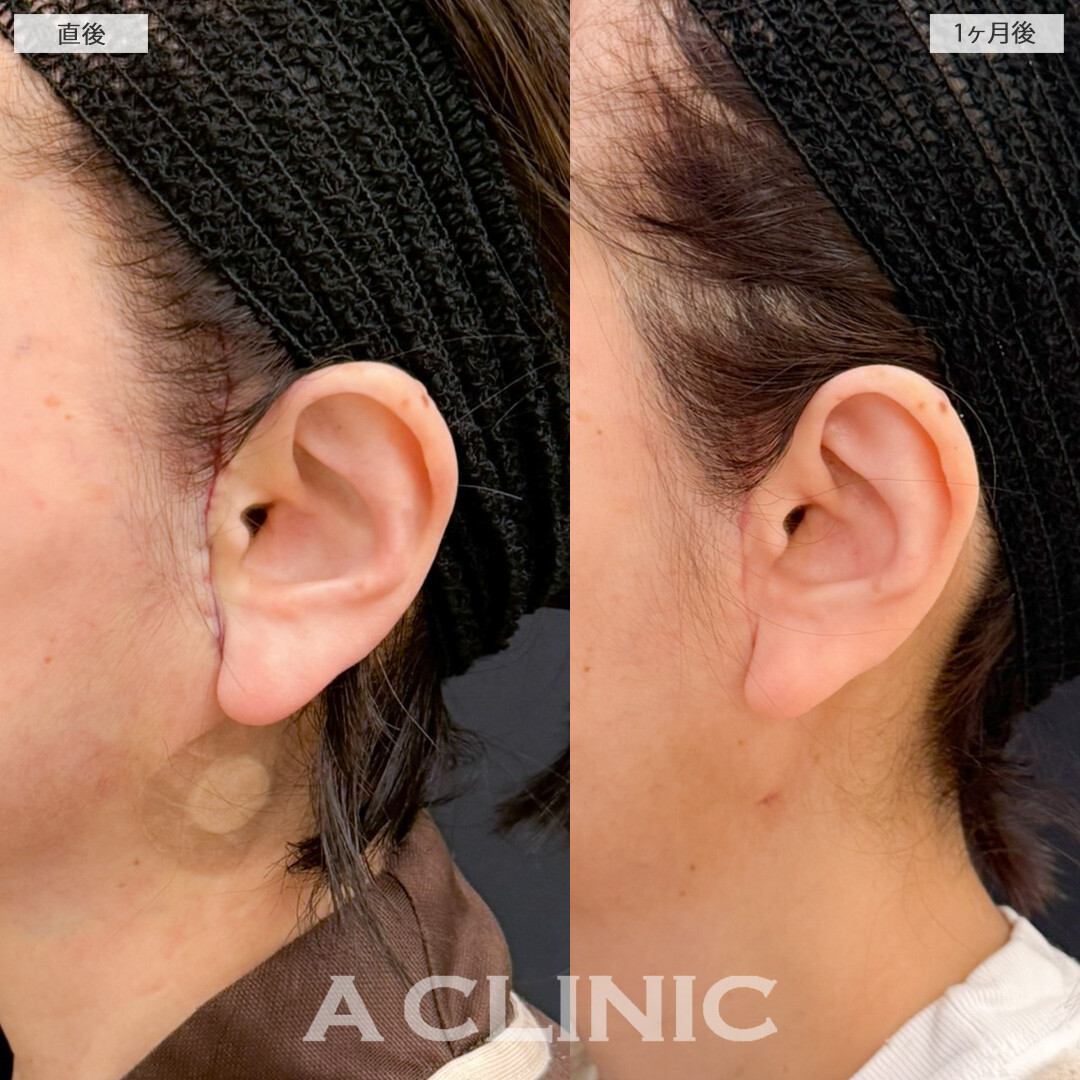 【直後の傷跡あり】1day小顔脂肪吸引とA式美肌たるみ切開でほうれい線と顔周りのたるみが気にならなくなりました！処置前と1ヶ月後の症例です(50代女性)