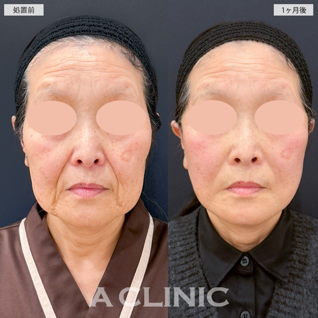 1day小顔脂肪吸引とA式美肌たるみ切開とナゾラビアルファット除去術でブルドッグ顔を解消したるみもしわも薄くなりました！処置前と1ヶ月後の症例です(60代女性)