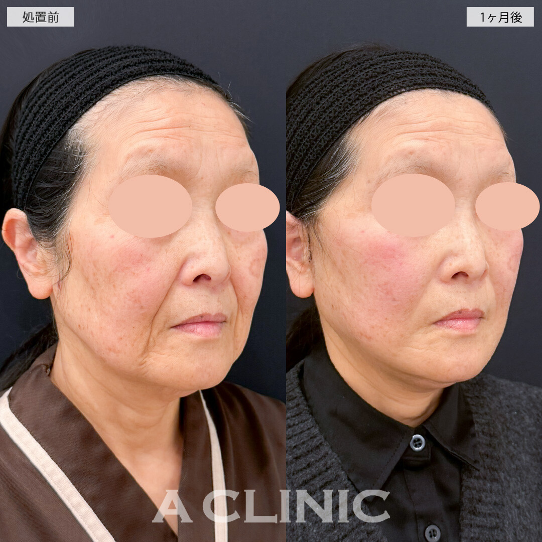 1day小顔脂肪吸引とA式美肌たるみ切開とナゾラビアルファット除去術でブルドッグ顔を解消したるみもしわも薄くなりました！処置前と1ヶ月後の症例です(60代女性)