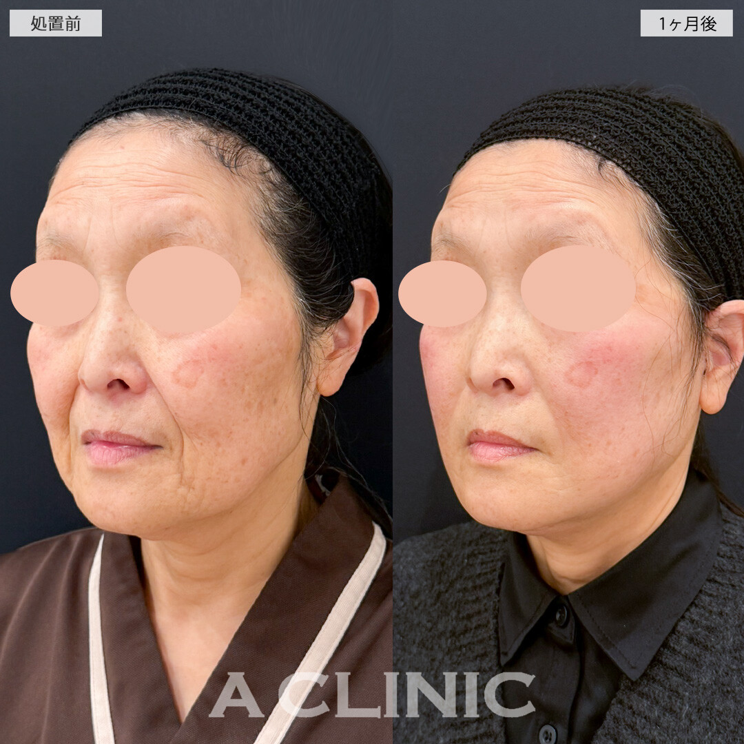 1day小顔脂肪吸引とA式美肌たるみ切開とナゾラビアルファット除去術でブルドッグ顔を解消したるみもしわも薄くなりました！処置前と1ヶ月後の症例です(60代女性)