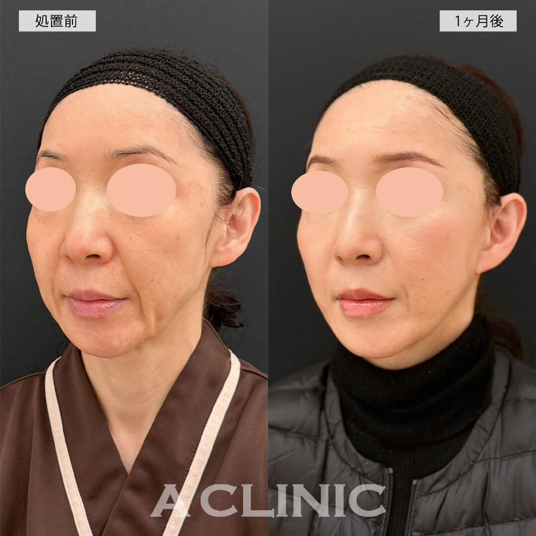 A式美肌たるみ切開なら後戻り無く綺麗な輪郭を保てます！こちら処置前と1ヶ月後の症例です(50代女性)