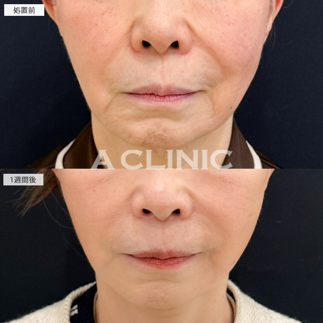 A式美肌たるみ切開でたるみもしわも同時に解消し周りと差がつけられます！処置前と1週間後の症例です(60代女性)