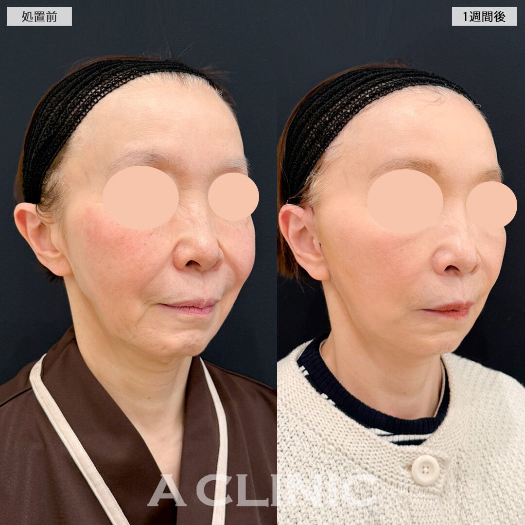 A式美肌たるみ切開でたるみもしわも同時に解消し周りと差がつけられます！処置前と1週間後の症例です(60代女性)