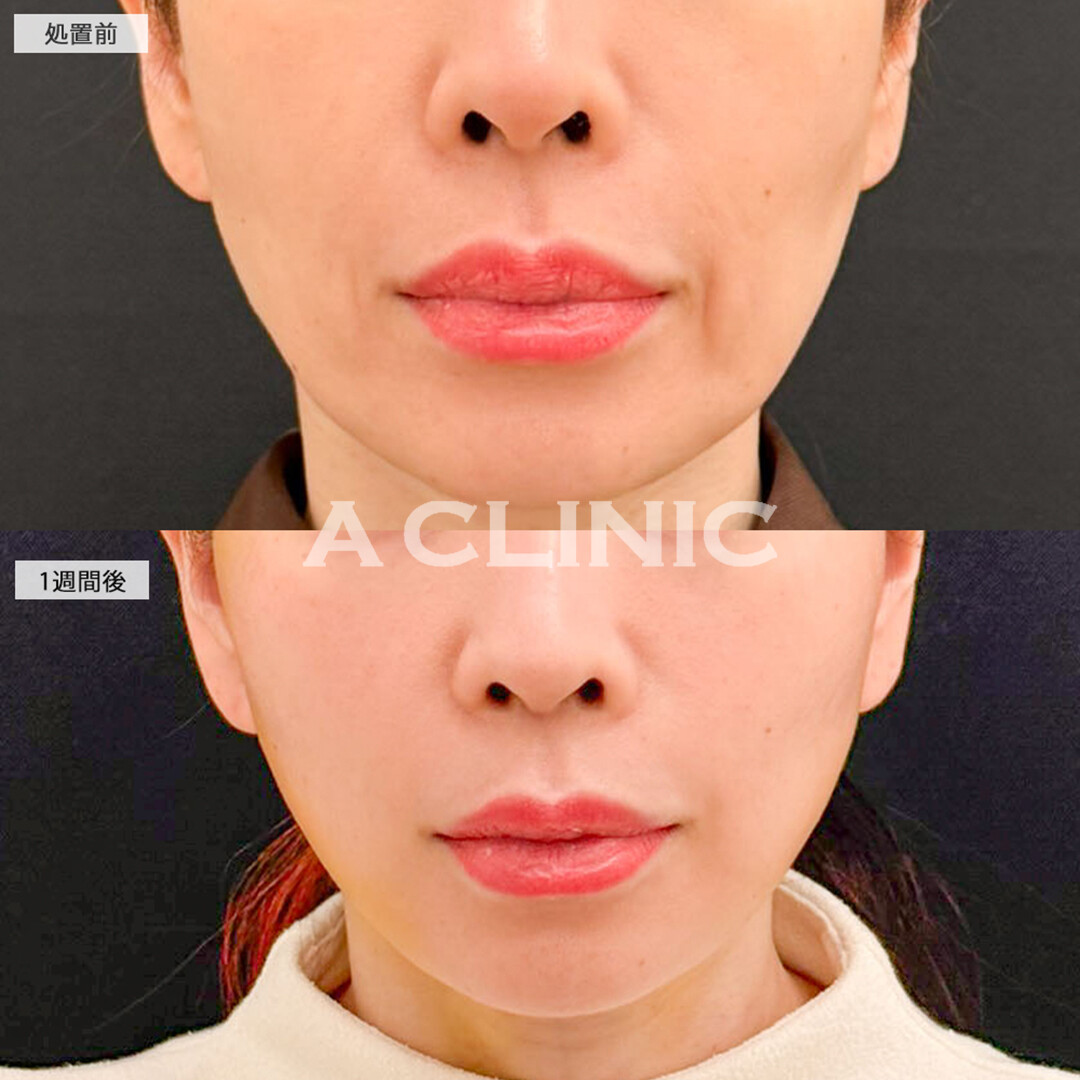A式美肌たるみ切開なら1週間後でも腫れ最小限でダウンタイムを過ごせます！こちら処置前と1週間後の症例です(40代女性)