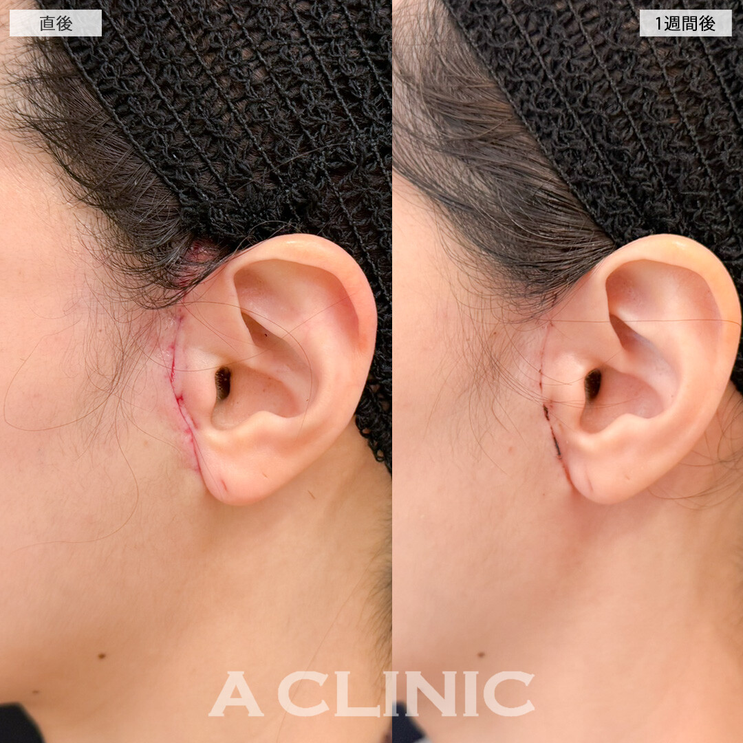 【直後の傷跡あり】A式美肌たるみ切開で年齢の出やすいほうれい線にアプローチ！処置前と1週間後の症例です(40代女性)