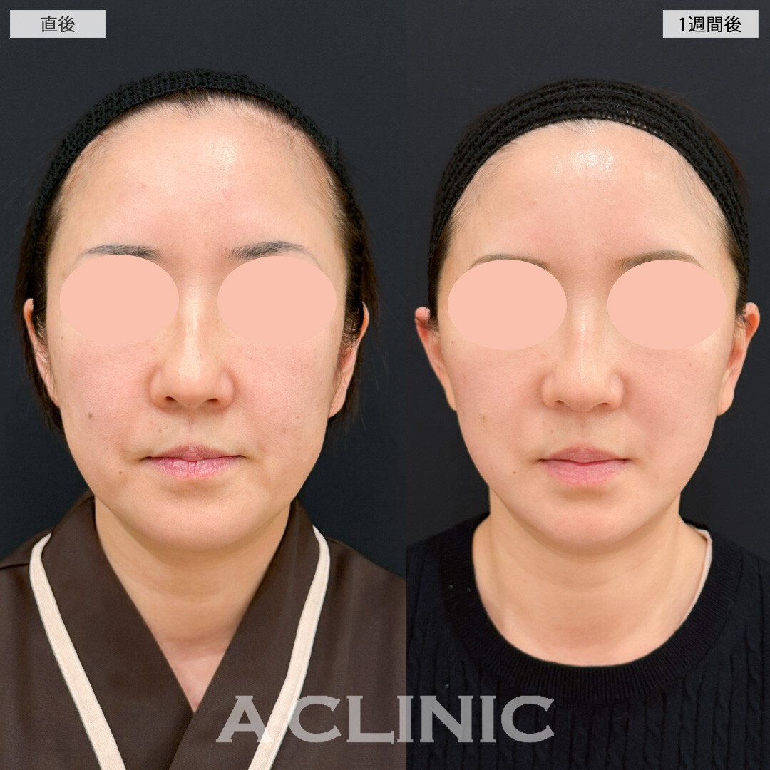 【直後の傷跡あり】A式美肌たるみ切開と顎下線への小顔エラボトックスで年齢を感じさせないいつまでも若々しいお顔に！処置前と1週間後の症例です(50代女性)