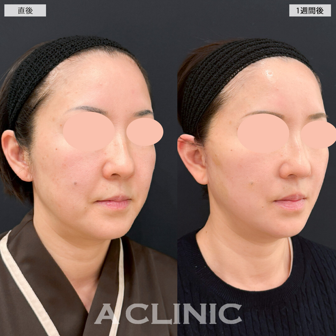 【直後の傷跡あり】A式美肌たるみ切開と顎下線への小顔エラボトックスで年齢を感じさせないいつまでも若々しいお顔に！処置前と1週間後の症例です(50代女性)