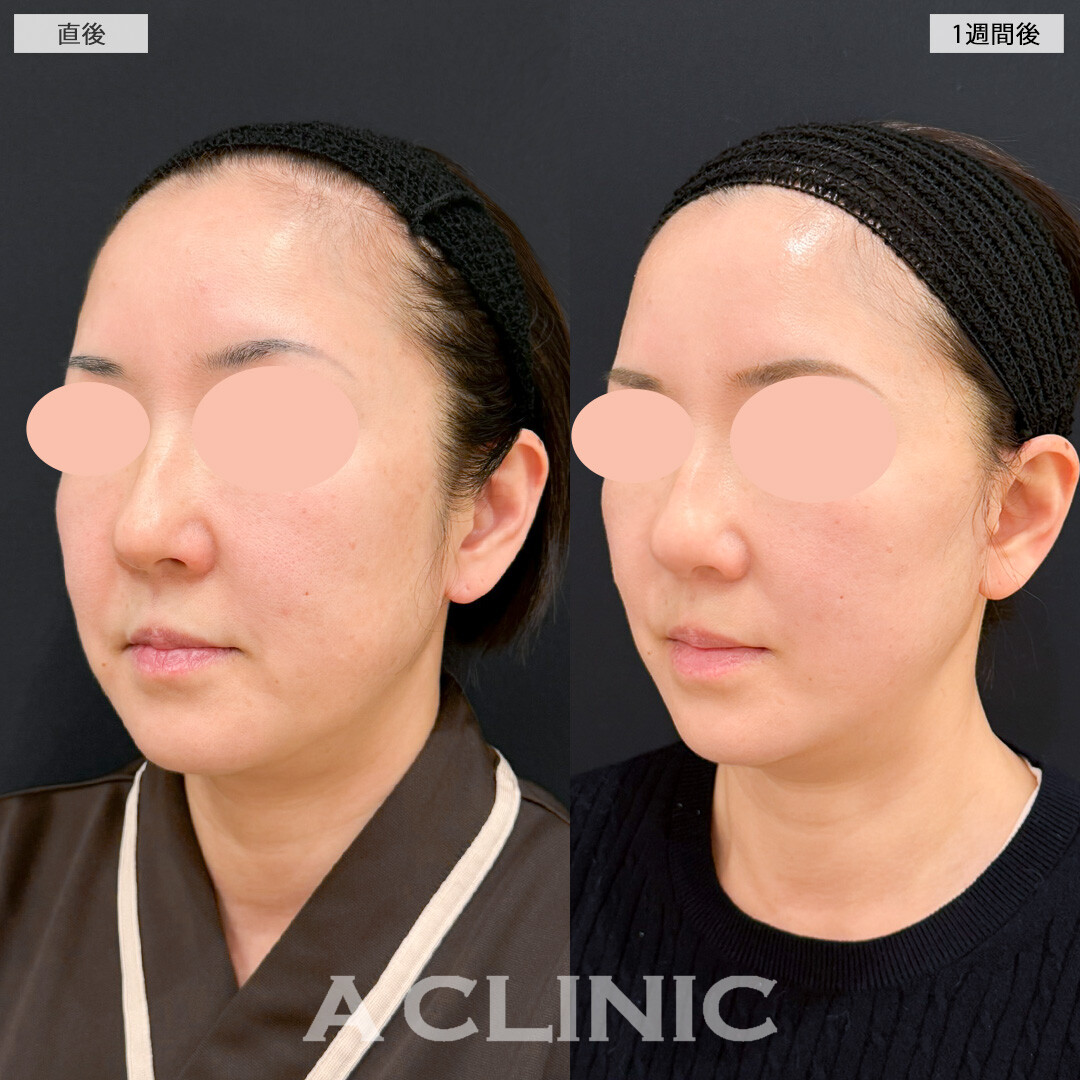 【直後の傷跡あり】A式美肌たるみ切開と顎下線への小顔エラボトックスで年齢を感じさせないいつまでも若々しいお顔に！処置前と1週間後の症例です(50代女性)