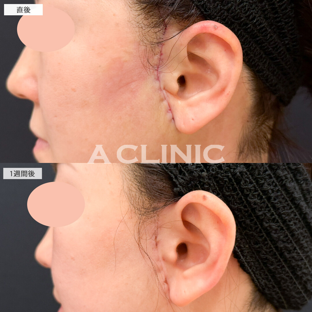 【直後の傷跡あり】A式美肌たるみ切開と顎下線への小顔エラボトックスで年齢を感じさせないいつまでも若々しいお顔に！処置前と1週間後の症例です(50代女性)