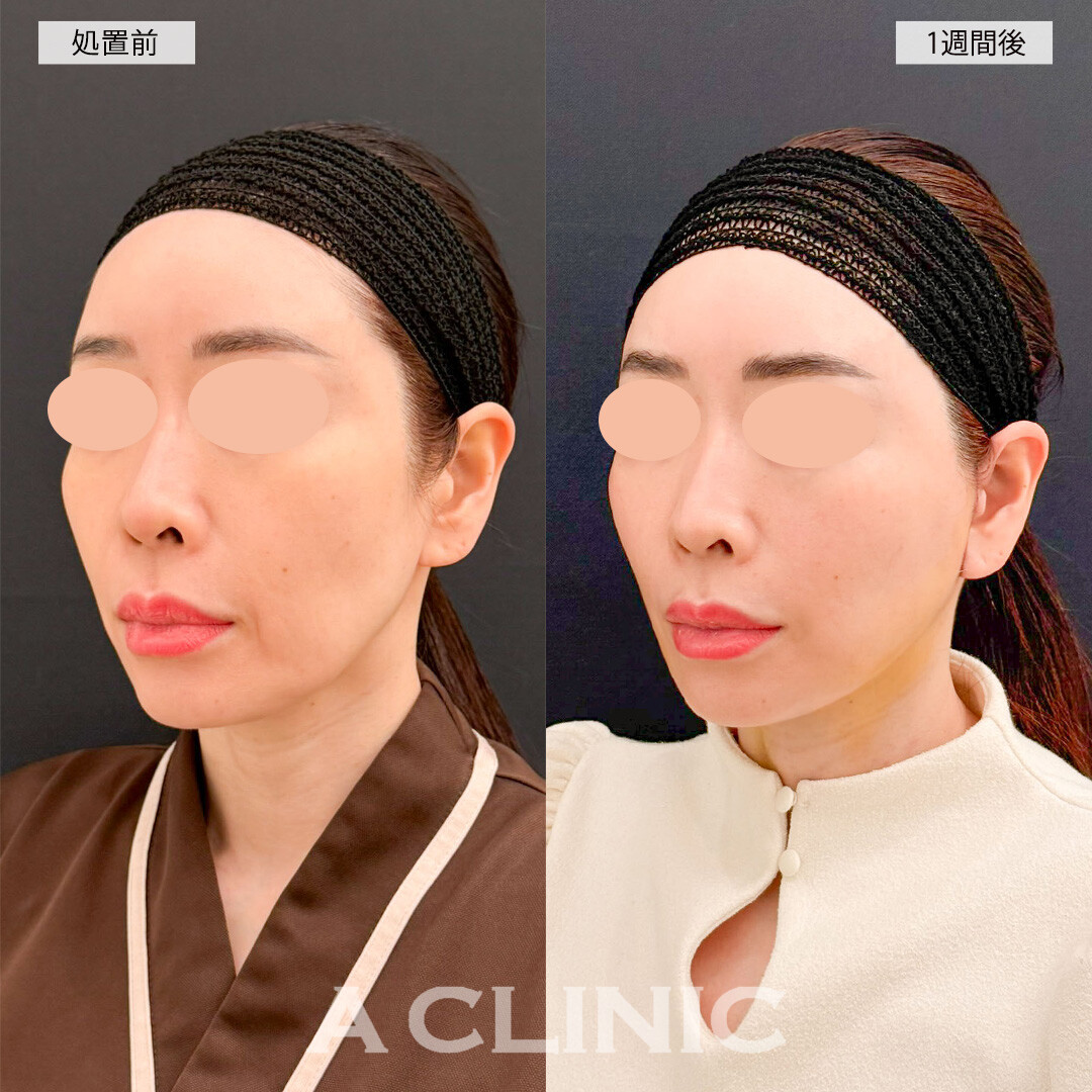 A式美肌たるみ切開なら1週間後でも腫れ最小限でダウンタイムを過ごせます！こちら処置前と1週間後の症例です(40代女性)
