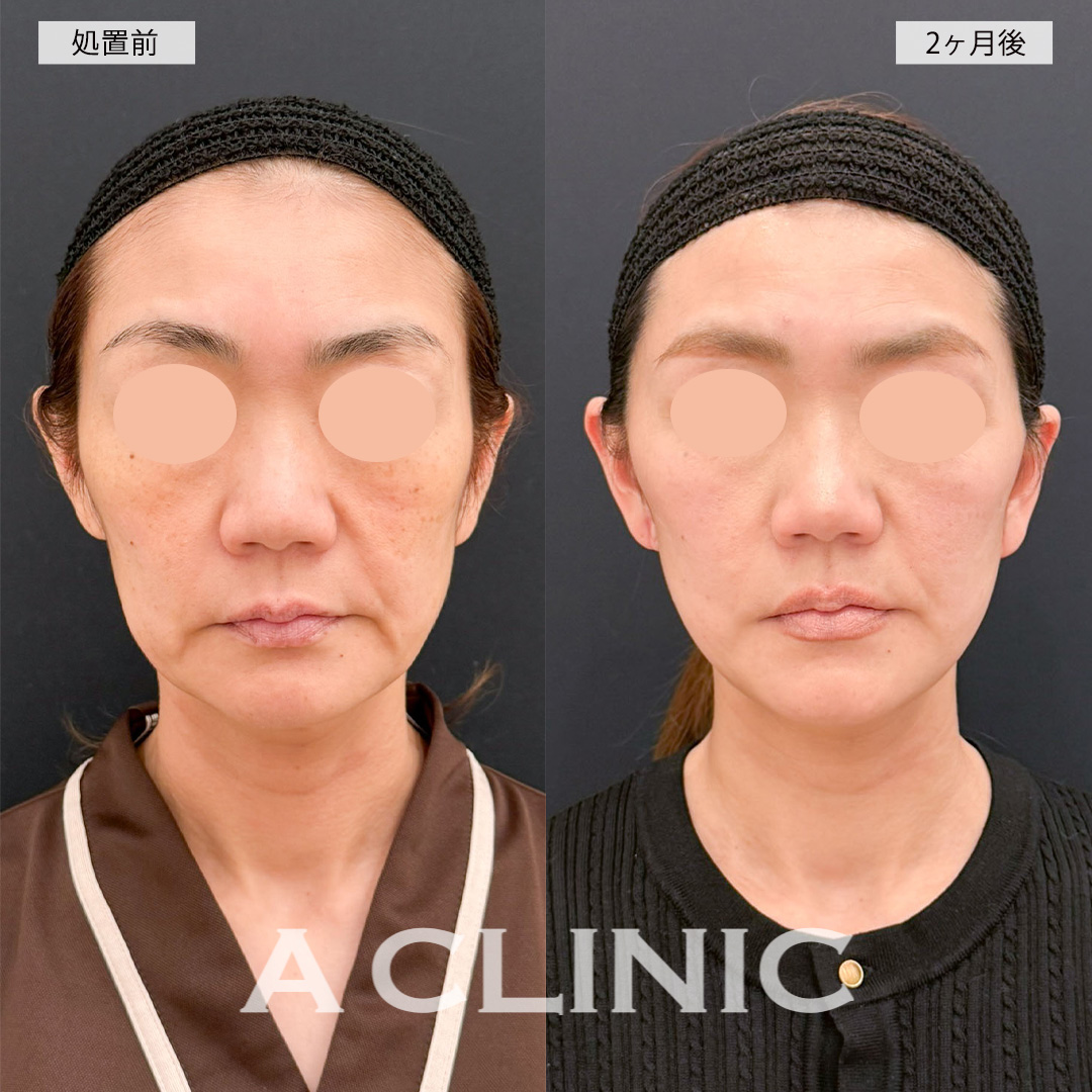 【直後の傷跡あり】A式美肌たるみ切開を行ったことでたるみが改善され自然な若返りに成功！こちら処置前から2ヶ月後までの症例です(40代女性)
