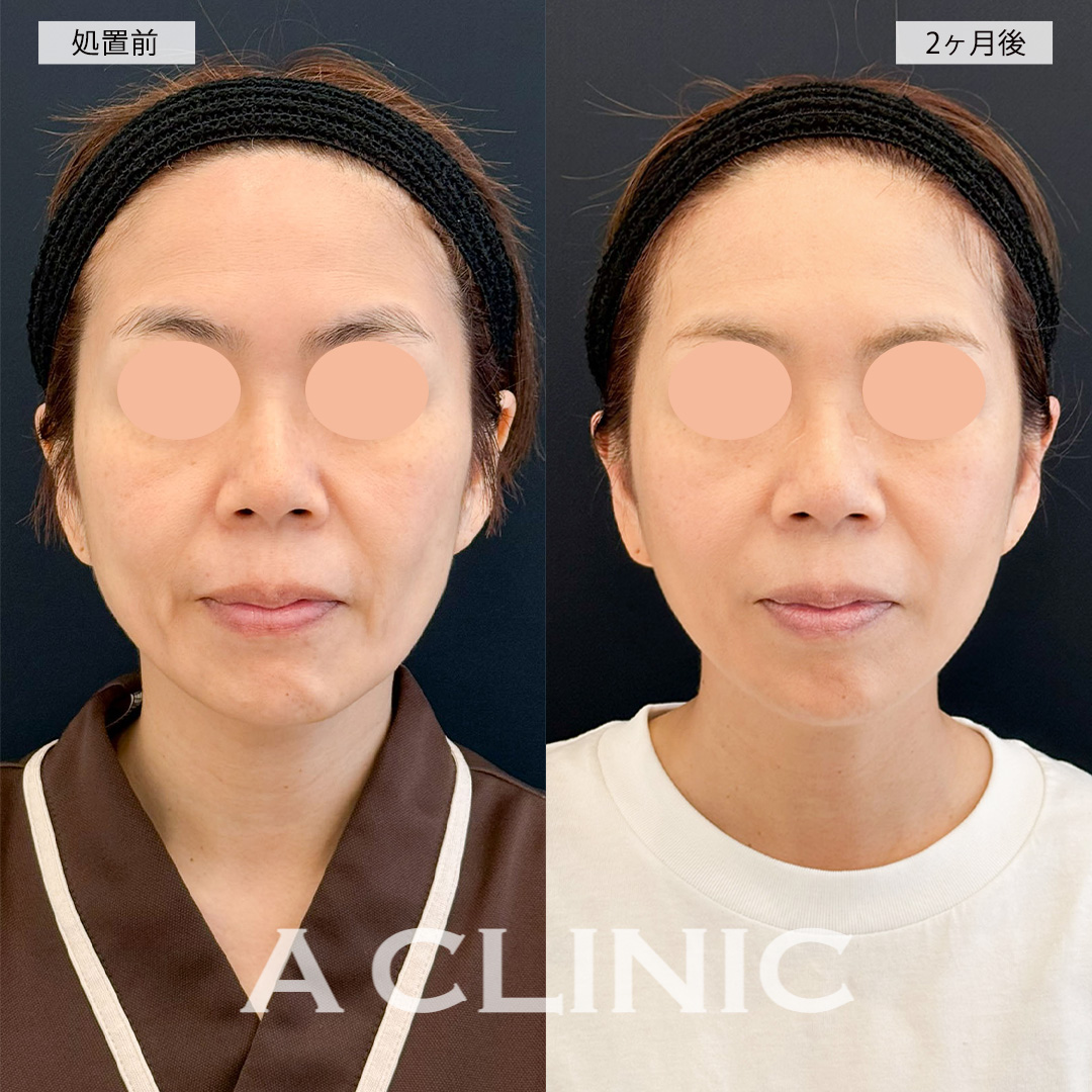 A式美肌たるみ切開でお顔のシワがかなり改善されました！こちら処置前と2ヶ月後の症例です(40代女性)