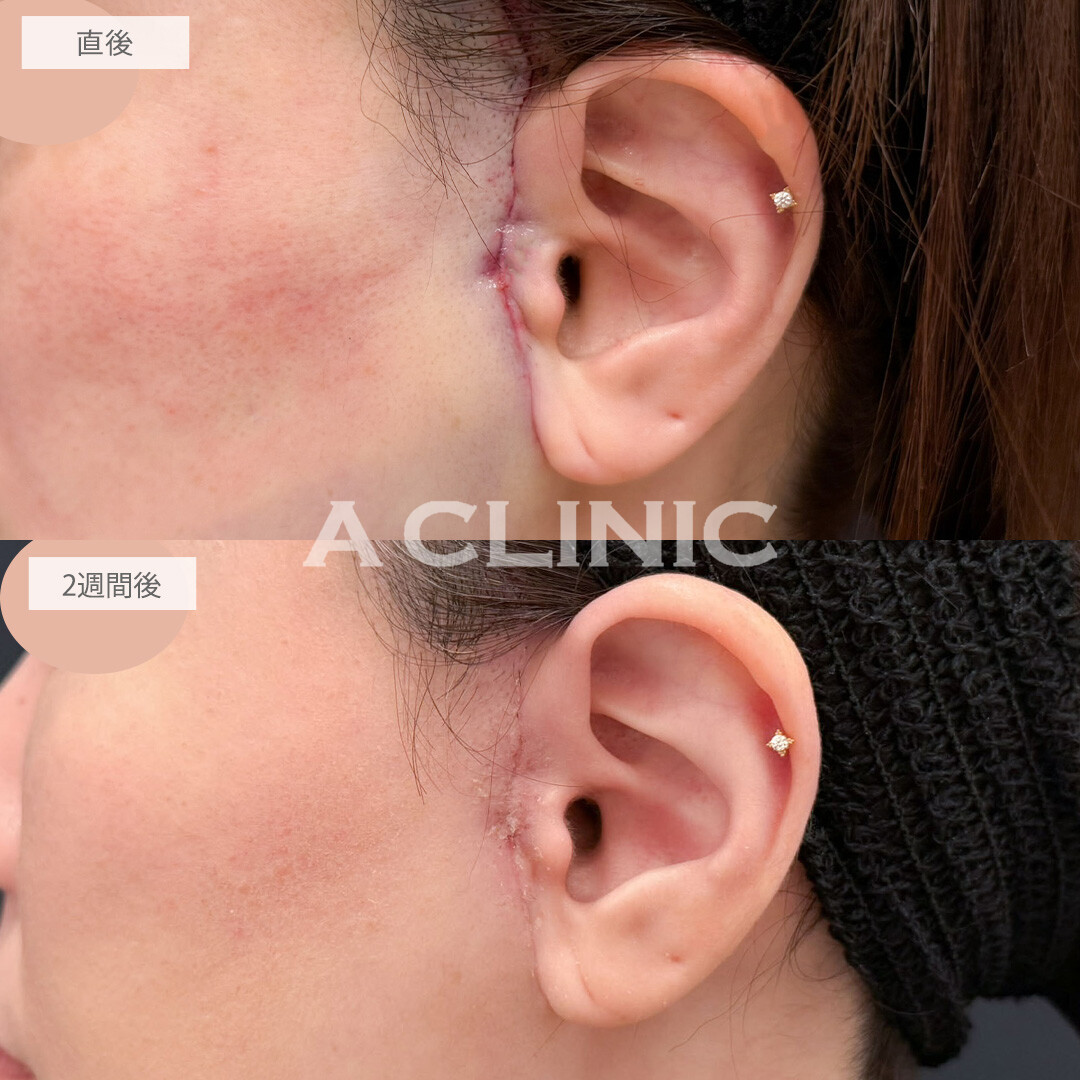 【直後の傷跡あり】A式美肌たるみ切開と1day小顔脂肪吸引でフェイスラインのたるみをすっきりさせて一気に若返りました！こちら処置前と2週間後の症例です(40代女性)
