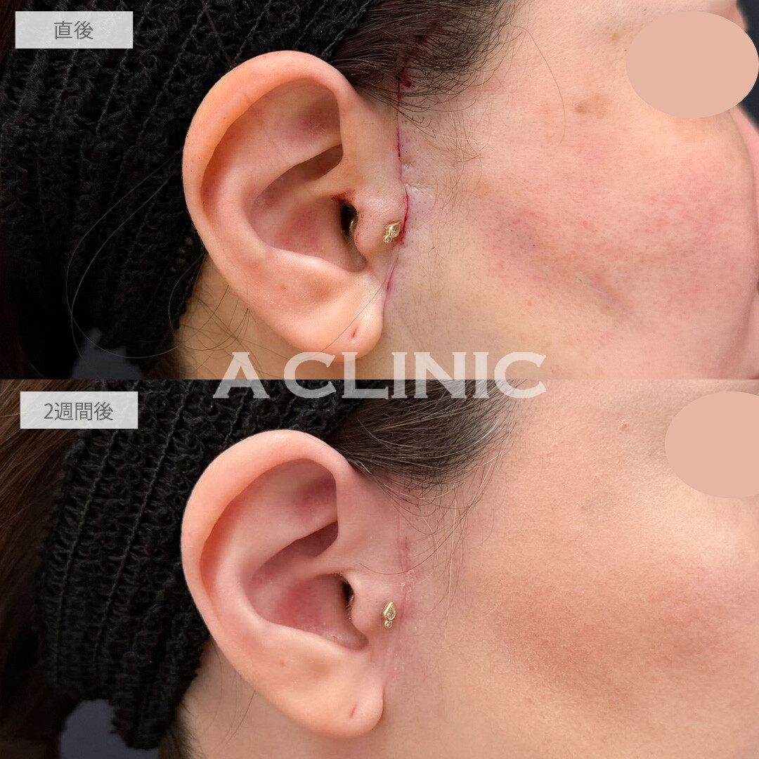 【直後の傷跡あり】A式美肌たるみ切開と1day小顔脂肪吸引でフェイスラインのたるみをすっきりさせて一気に若返りました！こちら処置前と2週間後の症例です(40代女性)