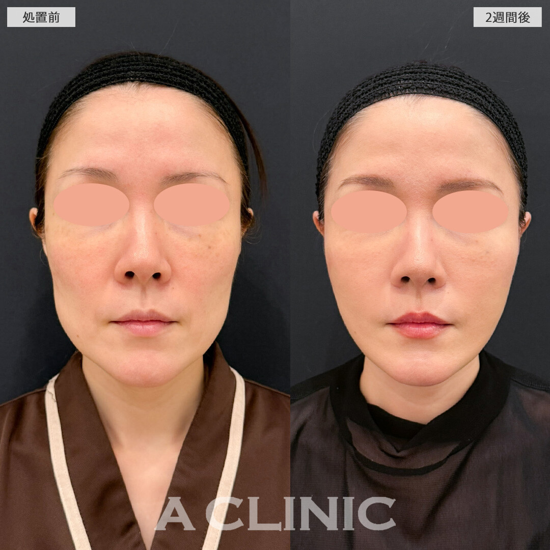 【直後の傷跡あり】A式美肌たるみ切開と1day小顔脂肪吸引でフェイスラインのたるみをすっきりさせて一気に若返りました！こちら処置前と2週間後の症例です(40代女性)