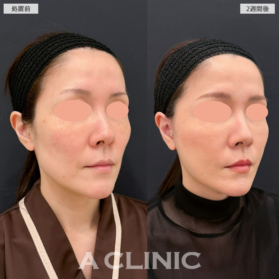 【直後の傷跡あり】A式美肌たるみ切開と1day小顔脂肪吸引でフェイスラインのたるみをすっきりさせて一気に若返りました！こちら処置前と2週間後の症例です(40代女性)