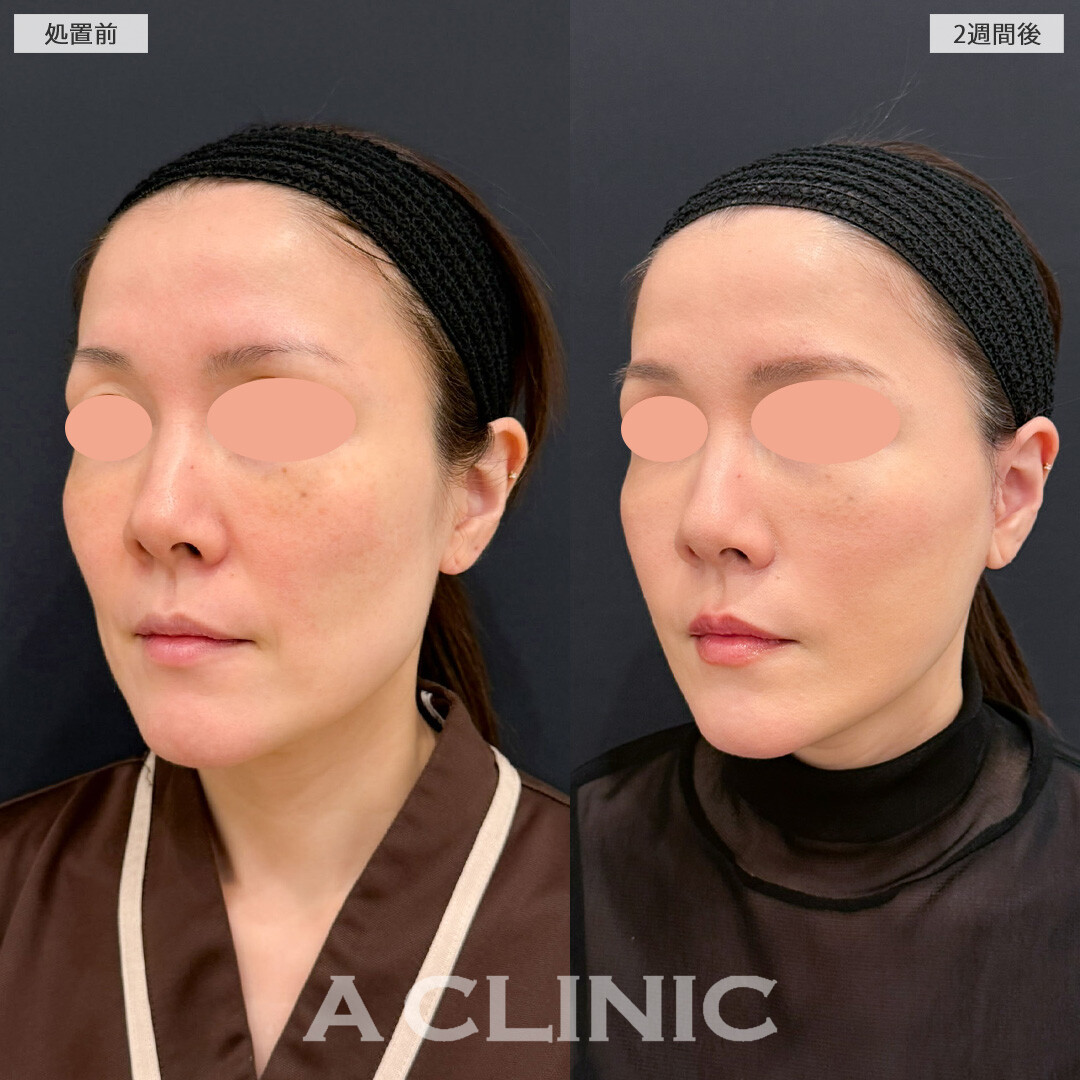 【直後の傷跡あり】A式美肌たるみ切開と1day小顔脂肪吸引でフェイスラインのたるみをすっきりさせて一気に若返りました！こちら処置前と2週間後の症例です(40代女性)
