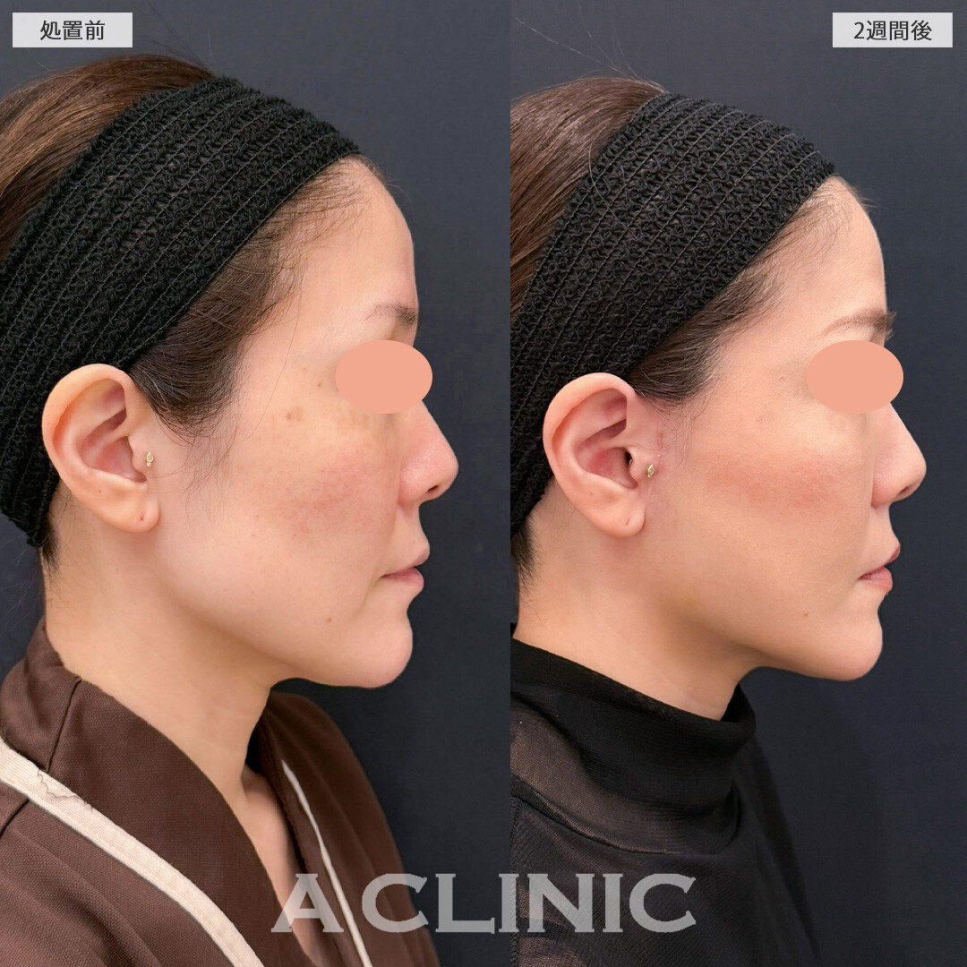 【直後の傷跡あり】A式美肌たるみ切開と1day小顔脂肪吸引でフェイスラインのたるみをすっきりさせて一気に若返りました！こちら処置前と2週間後の症例です(40代女性)
