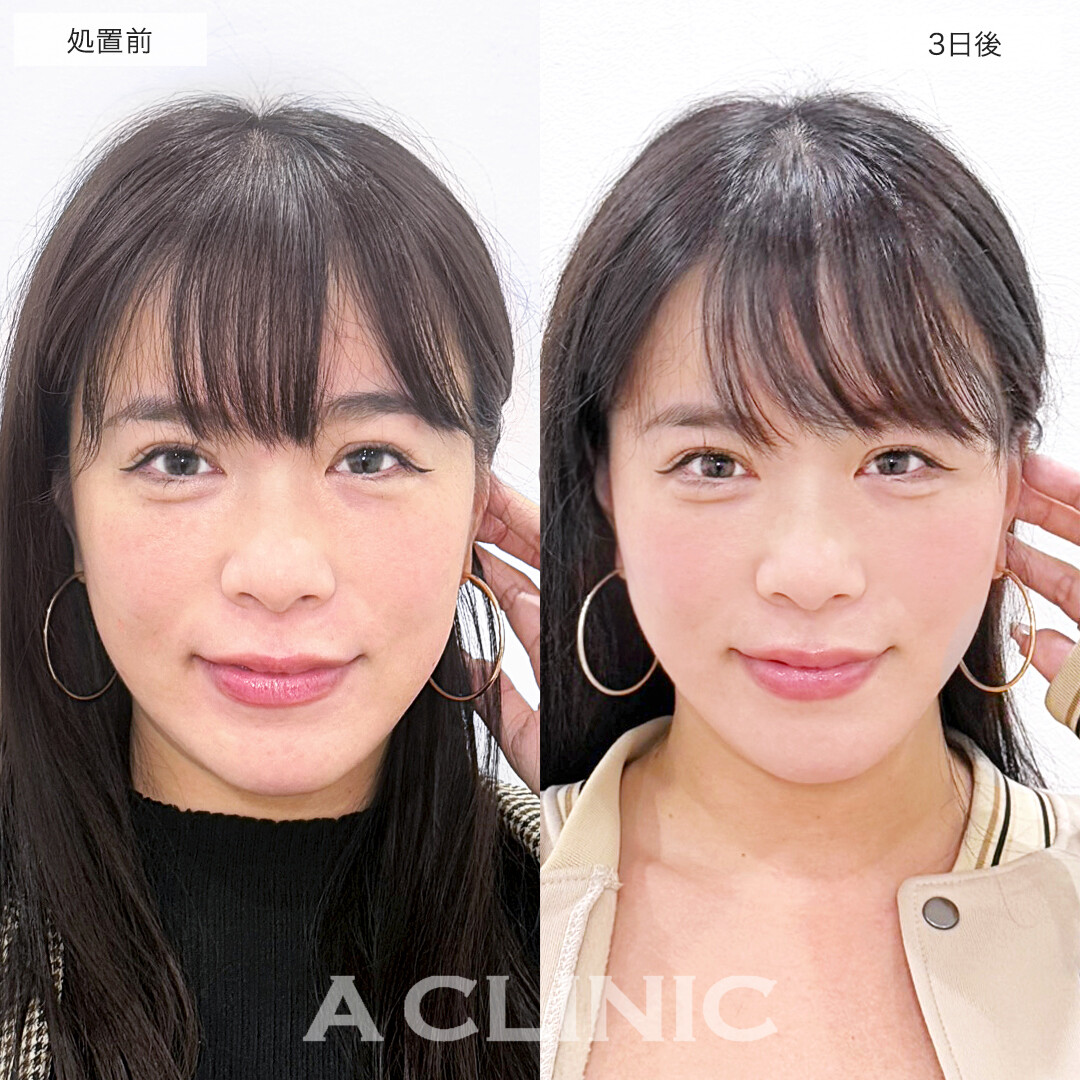 A式美肌たるみ切開でたるみが消えてスッキリ若見え小顔！処置前と直後と3日後の症例です(30代女性）