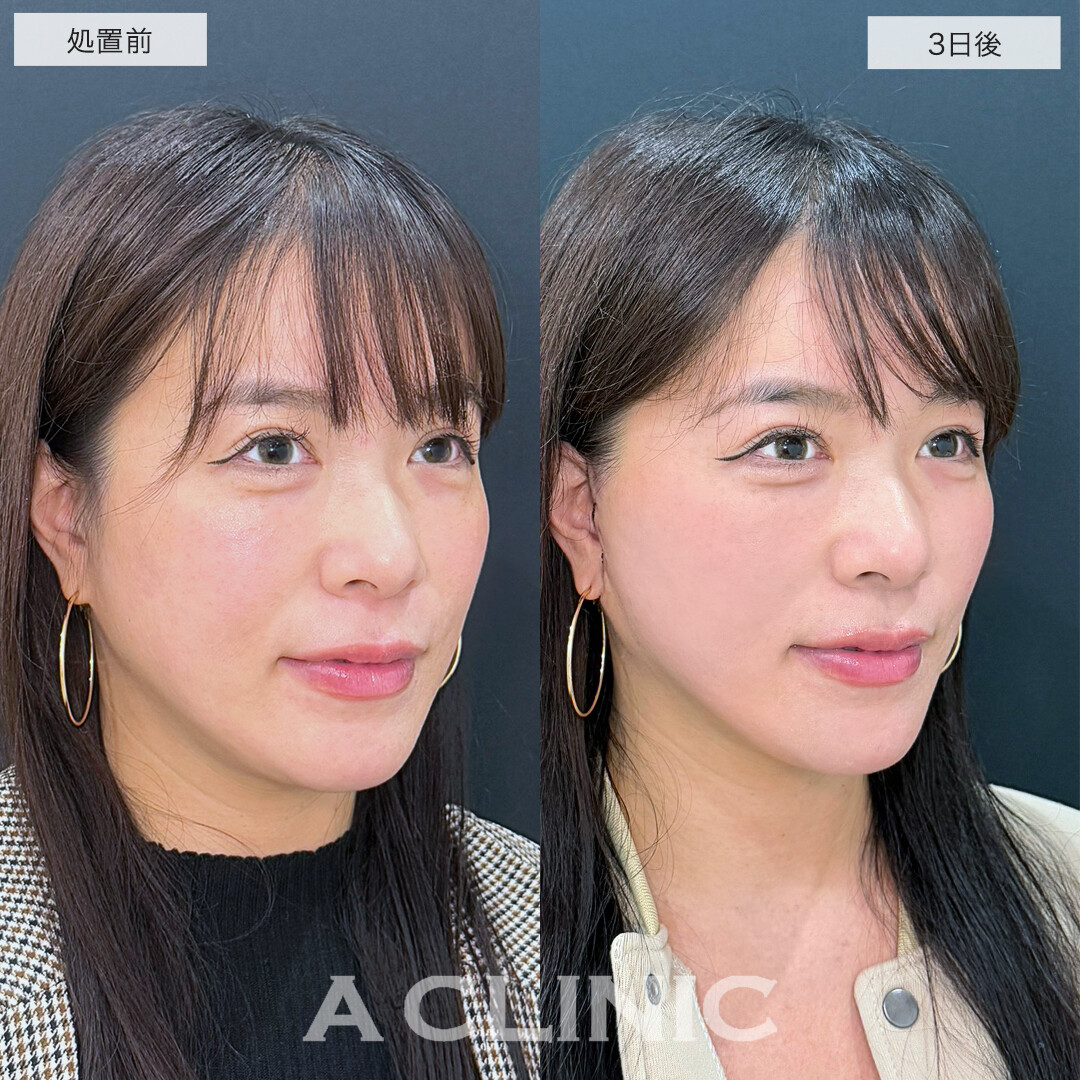 A式美肌たるみ切開でたるみが消えてスッキリ若見え小顔！処置前と直後と3日後の症例です(30代女性）
