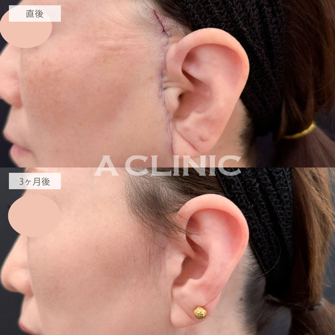 【直後の傷跡あり】A式美肌たるみ切開と1day小顔脂肪吸引でもたつきを除去して若返りました！こちら処置前と3ヶ月後の症例です(50代女性)