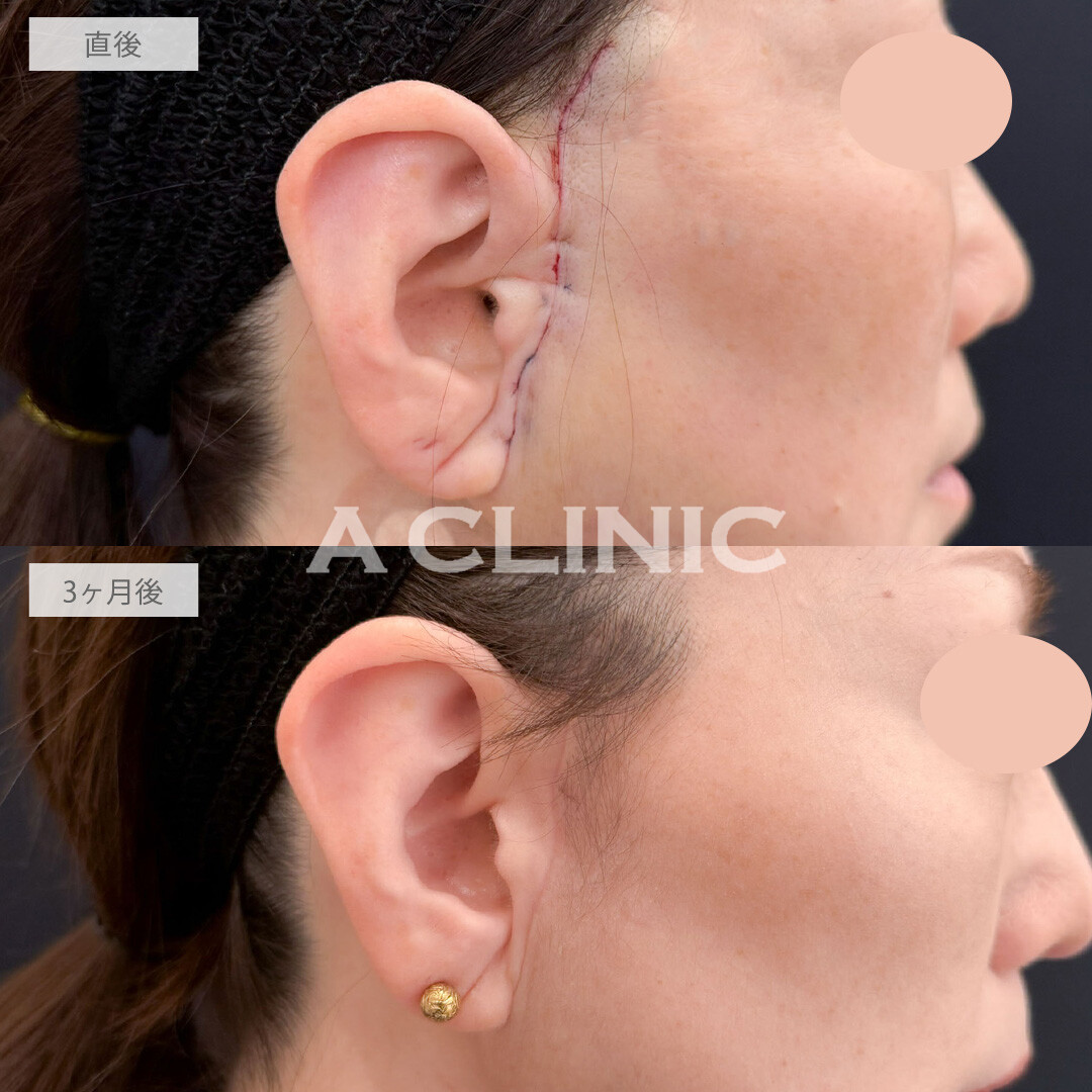 【直後の傷跡あり】A式美肌たるみ切開と1day小顔脂肪吸引でもたつきを除去して若返りました！こちら処置前と3ヶ月後の症例です(50代女性)