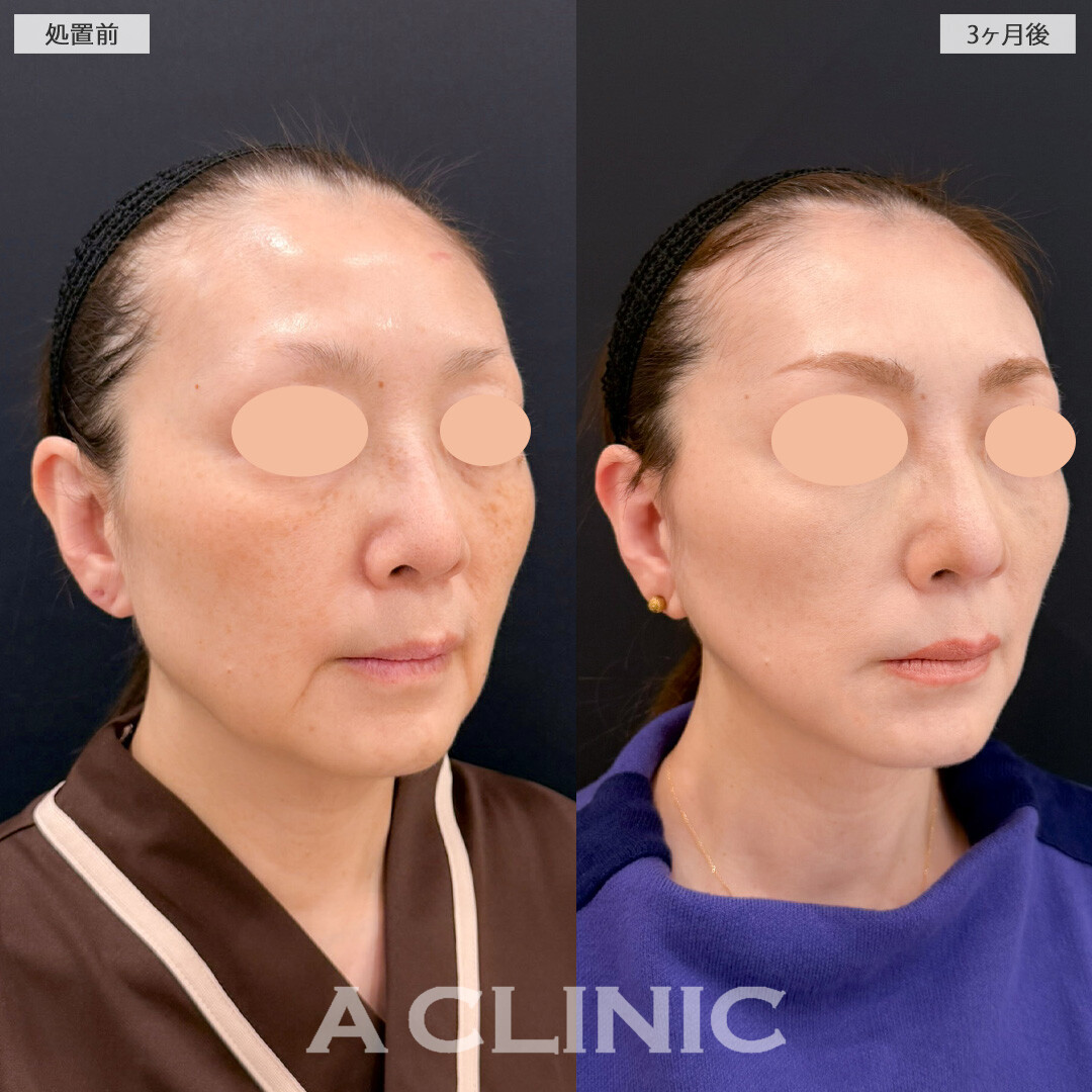 【直後の傷跡あり】A式美肌たるみ切開と1day小顔脂肪吸引でもたつきを除去して若返りました！こちら処置前と3ヶ月後の症例です(50代女性)