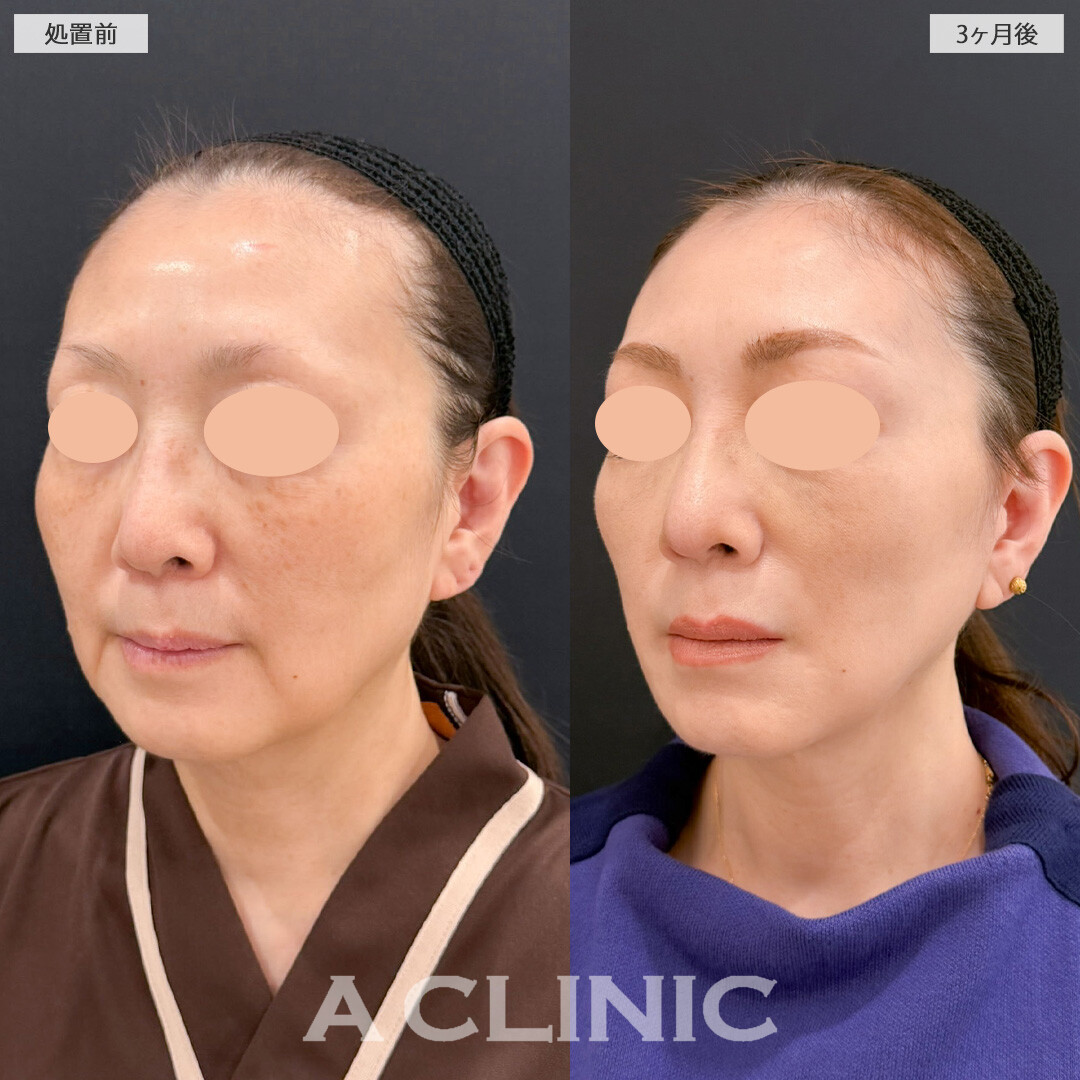 【直後の傷跡あり】A式美肌たるみ切開と1day小顔脂肪吸引でもたつきを除去して若返りました！こちら処置前と3ヶ月後の症例です(50代女性)
