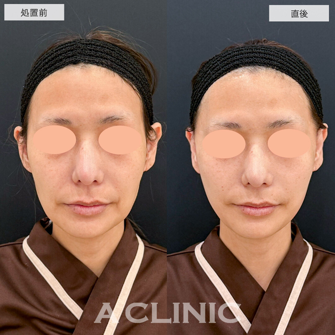 A式美肌たるみ切開で直後から年齢によるたるみが解消しました!こちら処置前と直後の症例です(40代女性)