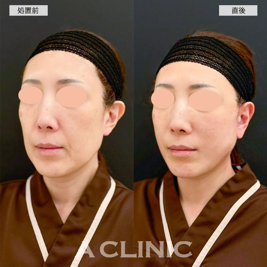 A式美肌たるみ切開なら直後からリフトアップ効果を実感できます！(50代女性)
